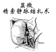 腹腔鏡下精索靜脈曲張微創(chuàng)術(shù)