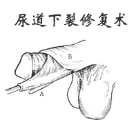 尿道下裂修復(fù)術(shù)
