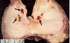 前列腺結石