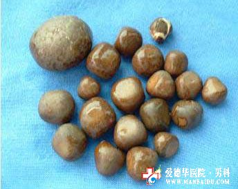 男性為何易患前列腺結(jié)石