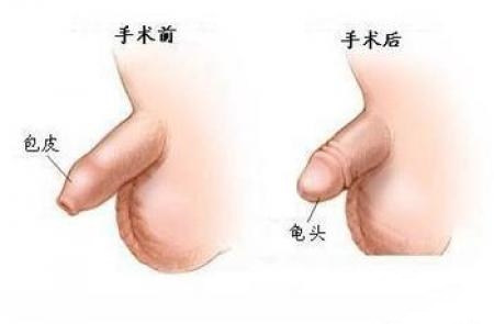 在九江市包皮過長什么價錢