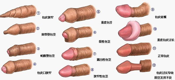 九江市包皮包莖哪里好