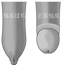 包皮怎樣為過長