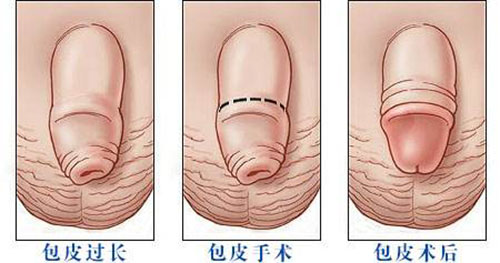 九江市_哪個(gè)治包皮_