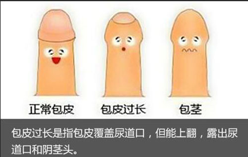 男人包皮圖片.